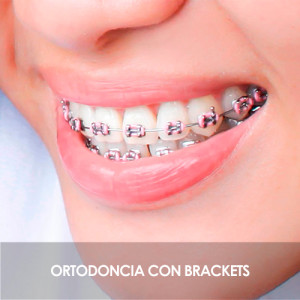Tratamiento DUO Tratamiento DUO. Ortodoncia con brackets.