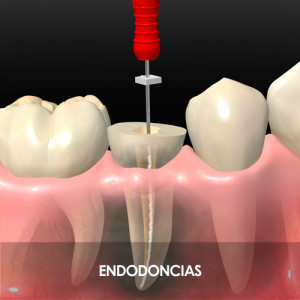 Tratamiento DUO Tratamiento DUO. Endodoncias.