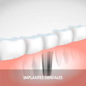 Tratamiento DUO Tratamiento DUO. Implantes Dentales.