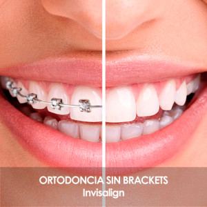 Tratamiento DUO Tratamiento DUO. Ortodoncia sin brackets. Invisalign